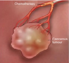 Trans arterial Chemoembolization (TACE) 1st step