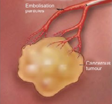 Trans arterial Chemoembolization (TACE) 2nd step