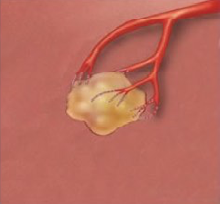 Trans arterial Chemoembolization (TACE) 3rd step