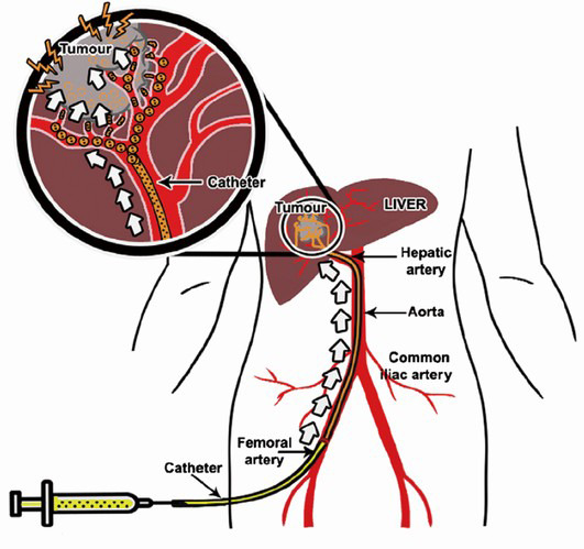 Trans arterial Chemoembolization (TACE)